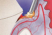 Asigurarea hemostazei și controlul fluidului gingival - stamil depot dentar