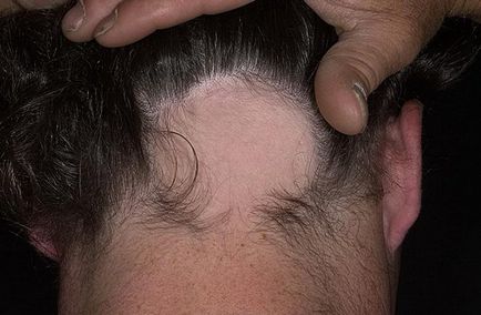 Alopecia areata factori de risc, simptome, tratament (foto, video)