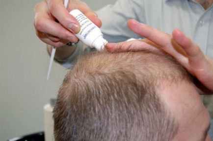 Foltos kopaszodás kockázati tényezők, tünetek, kezelés (fotó, videó) (alopecia) Foltos kopaszodás kockázati tényezők, tünetek, kezelés (fotó, videó)