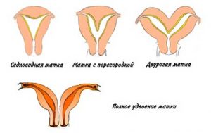 Unicorn șanse uterine de concepție și de naștere