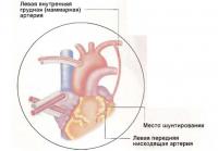 Operația cardiacă pentru transplantul vascular (tratament - cardiologie)