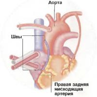 Операція на серці з пересадки судини (лікування - кардіологія)