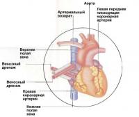 Операція на серці з пересадки судини (лікування - кардіологія)