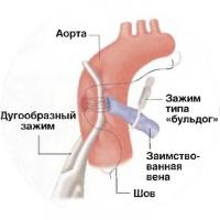 Операція на серці з пересадки судини (лікування - кардіологія)