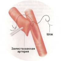 Operația cardiacă pentru transplantul vascular (tratament - cardiologie)