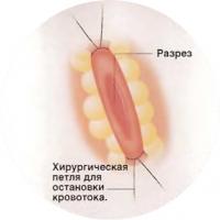 Операція на серці з пересадки судини (лікування - кардіологія)