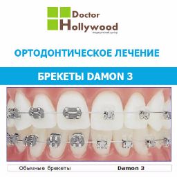 Ортодонтія москва поставити брекети на зуби, виправлення прикусу, поставити брекети ціна в москві