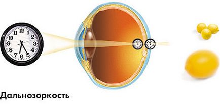 Особливості операцій при далекозорості, про хвороби очей