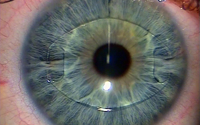 Caracteristici ale operațiilor pentru diabet, despre bolile oculare