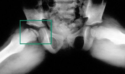 Osteochondropatie - clasificarea bolii și metodele de tratament