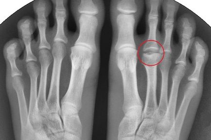 Osteochondropatie - clasificarea bolii și metodele de tratament