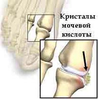 Гостра і хронічна подагра