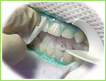 Albirea dintilor, centru de implant clinic dentar
