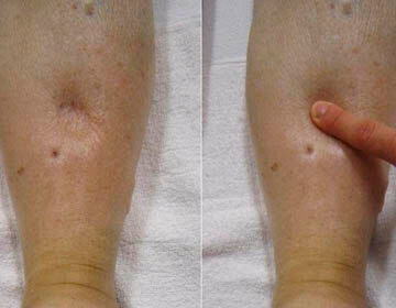 Набряки ніг при варикозі причини, фото, лікування