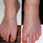 Edemul (umflarea) picioarelor cu vene varicoase care suferă cum trebuie tratate