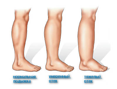 Набряки при варикозі ніг - симптоми, причини і лікування