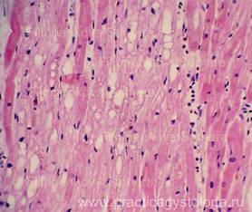 Dystrofii parenchimatoase - practici histologiști