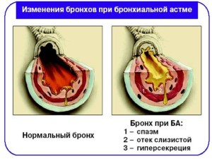 Първа помощ за астма и неговата превенция