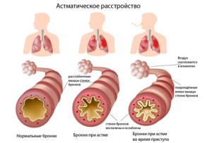 Elsősegély asztma, illetve annak megelőzésére (első) Elsősegély asztma és megelőzése