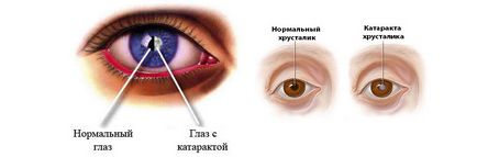 Перші ознаки катаракти очей