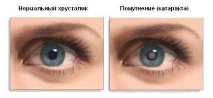 Перші ознаки катаракти очей