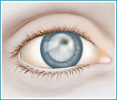 Перші ознаки катаракти очей