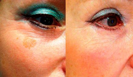 Tratarea petelor pigmentate, fotografie