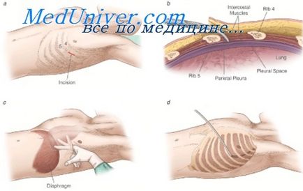 talkum pleurodesis