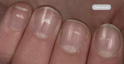 Чому нігті уражаються на псоріаз і в чому особливість лікування