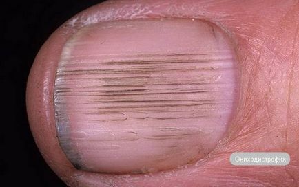 De ce unghiile sunt afectate de psoriazis și care este particularitatea tratamentului
