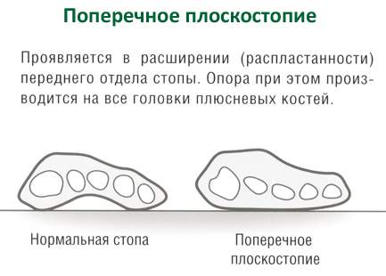 Transversal simptome picioarele plate și tratament