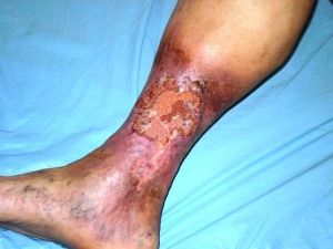 Posta trombózisos betegség (ptfb) láb vénás kezelést és okai