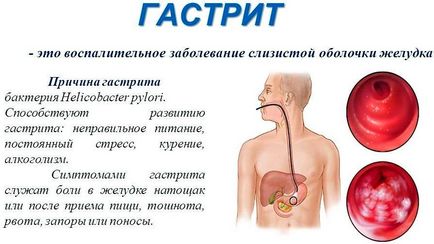 Aciditatea crescută a stomacului - cauze și tratament