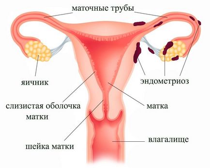 Cauze de endometrioză, simptome și posibilitatea de sarcină în endometrioză