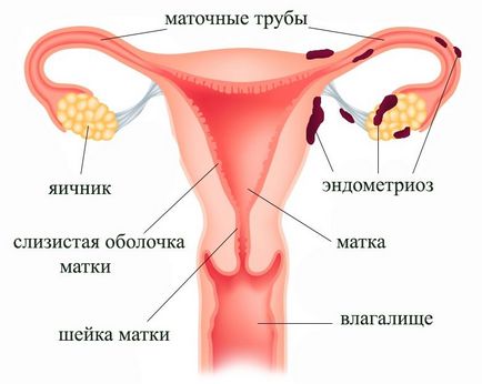 Az okok a endometriózis, a tünetek és a terhesség lehetőségét endometriosis