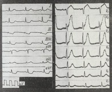 Infarcte penetrante - criterii electrocardiografice pentru infarctul miocardic - infarct miocardic -