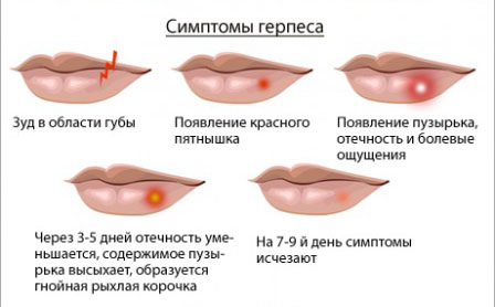 Застуда на губі як лікувати