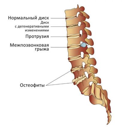 Протрузія диска l4 l5 що це таке, симптоми і лікування