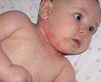 Pemphigus felnőtteknél a tünetek és a kezelés a vírus, az igaz, és a levél-seborrheás bladderworts (felnőtt) Pemphigus felnőtteknél a tünetek és a kezelés a vírus, az igaz, és a levél-seborrheás bladderworts