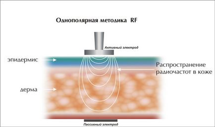 Радіочастотний (rf) ліфтинг