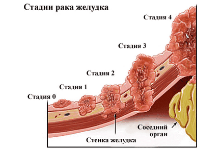 Рак шлунка - симптоми, причини розвитку, діагностика раку шлунка, лікування раку шлунка та