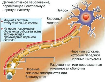 A korai tünetek sclerosis multiplex