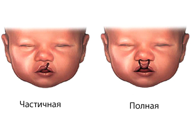 Розщепленими небо (вовча паща) огляд захворювання, медичний портал eurolab