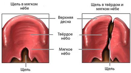 Розщепленими небо (вовча паща) огляд захворювання, медичний портал eurolab