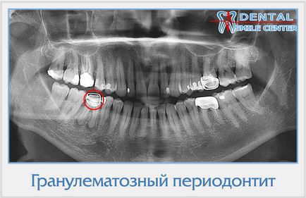 X-ray betegségek diagnosztizálása a fogak és a pofák (betegségek) Fogászati röntgen diagnózis betegségek és pofák
