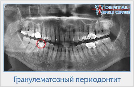 Рентгенодіагностика захворювань зубів і щелеп