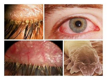 Cicatricea provoacă apariția, simptomele, tratamentul și prevenirea demodicozelor pe gene, fotografii și