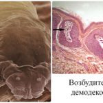 Cicatricea provoacă apariția, simptomele, tratamentul și prevenirea demodicozelor pe gene, fotografii și