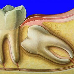 Ретінірованний зуб мудрості і методи його лікування