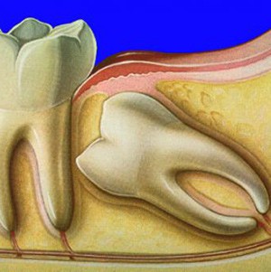 Dinte de înțelepciune reținută și metode de tratare a acesteia